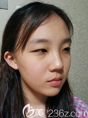 在韓國樂于麗顏整形醫(yī)院做韓式雙眼皮術(shù)前面診 在韓國樂于麗顏整形醫(yī)院做韓式雙眼皮術(shù)前面診