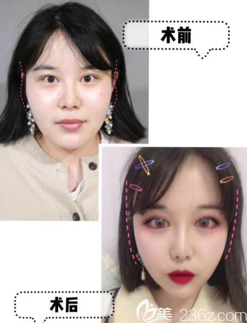 韓國寶士麗玻尿酸豐太陽穴真人案例 韓國寶士麗玻尿酸豐太陽穴真人案例