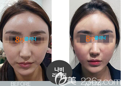 韓國815抗衰老面部提升前后效果對比圖