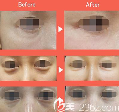 韓國815抗衰老眼袋治療前后照片 韓國815抗衰老眼袋治療前后照片