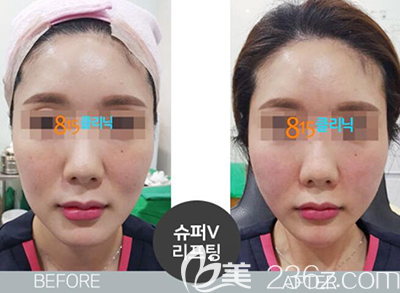 韓國815抗衰老面部提升案例效果前后對(duì)比圖 韓國815抗衰老面部提升案例效果前后對(duì)比圖