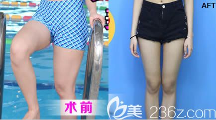 長春奧拉克做大腿吸脂前后對比圖 長春奧拉克做大腿吸脂前后對比圖