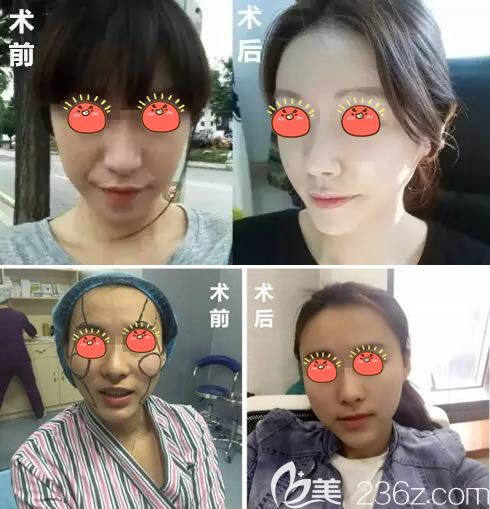 陳樹(shù)科自體脂肪填充案例