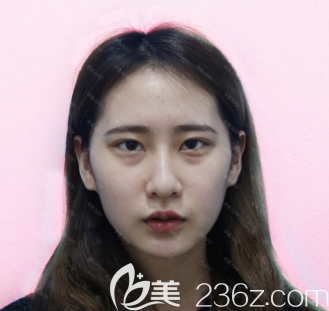 在廣州紫馨做祛眼袋手術(shù)前的樣子 在廣州紫馨做祛眼袋手術(shù)前的樣子