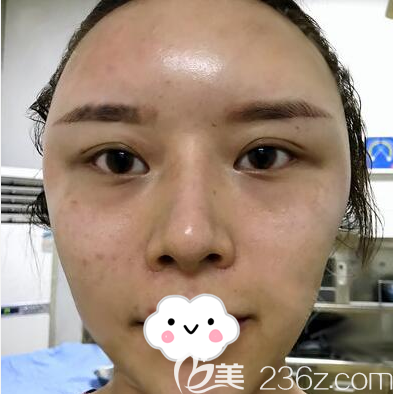 <!--<i data=20240703-sp></i>-->脂肪填充額頭太陽穴術(shù)后即刻