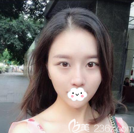 自體脂肪面部填充術(shù)一個月恢復(fù)照