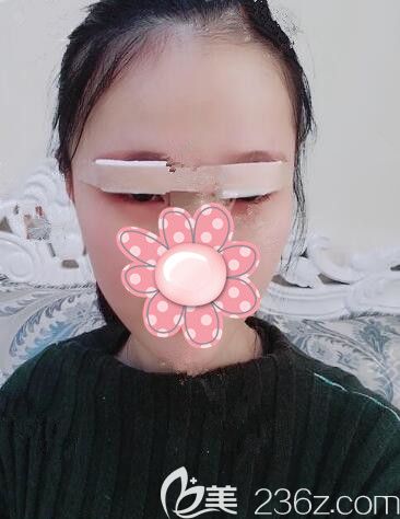 剛做完韓式精切雙眼皮術后即刻眼部腫脹