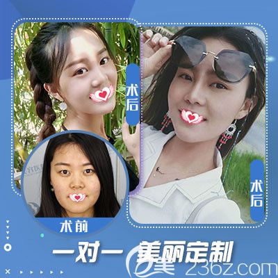 石家莊藍(lán)山注射玻尿酸案例