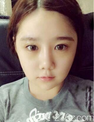 韓國ID整形醫(yī)院自體脂肪面部填充+V臉提升案例術(shù)后效果圖