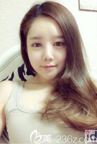 韓國id整形醫(yī)院面部輪廓整形真人案例恢復過程