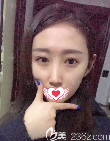 在石家莊雅芳亞做眼綜合術(shù)后10天慢慢消腫 在石家莊雅芳亞做眼綜合術(shù)后10天慢慢消腫