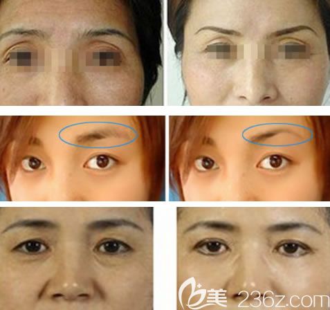 湖州尚麗宮玉展切眉手術(shù)案例