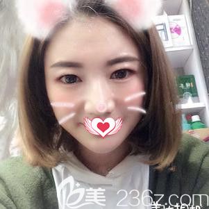 一直以為大方臉只能做面部吸脂來瘦臉 誰知找石家莊藍(lán)山杜建龍?jiān)洪L面診后做了自體脂肪面部填充術(shù)也能輕松變成心形臉