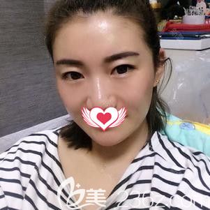 在石家莊藍(lán)山做脂肪填充面部后1個月恢復(fù)情況 在石家莊藍(lán)山做脂肪填充面部后1個月恢復(fù)情況