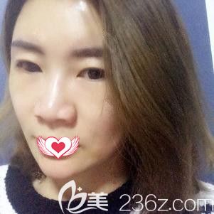 杜建龍院長為我自體脂肪填充術(shù)后16天慢慢消腫 杜建龍院長為我自體脂肪填充術(shù)后16天慢慢消腫