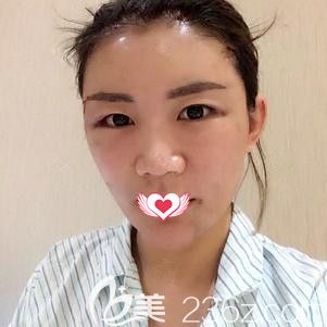 杜建龍院長為我做脂肪填充面部術(shù)后5天面部腫脹 杜建龍院長為我做脂肪填充面部術(shù)后5天面部腫脹