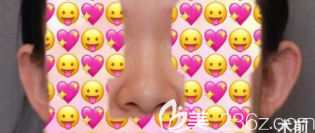 鼻綜合術(shù)前照片