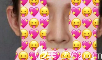 鼻綜合三個月的效果