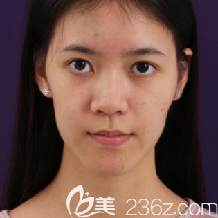 去東莞美立方做脂肪填充前的樣子 去東莞美立方做脂肪填充前的樣子