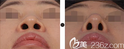 韓國(guó)韓娜鼻整形醫(yī)院假體隆鼻綜合整形案例前后效果對(duì)比圖 韓國(guó)韓娜鼻整形醫(yī)院假體隆鼻綜合整形案例前后效果對(duì)比圖