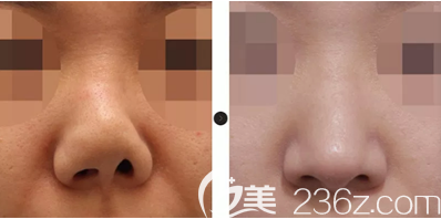 韓國(guó)韓娜鼻整形醫(yī)院假體隆鼻失敗修復(fù)案例 韓國(guó)韓娜鼻整形醫(yī)院假體隆鼻失敗修復(fù)案例