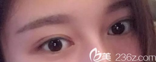 包頭葉子雙眼皮案例：我腫眼泡不嚴(yán)重 馬主任建議做韓式三點定位雙眼皮就可以了