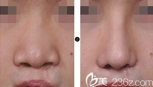 韓國韓娜鼻整形醫(yī)院張槿旭院長隆鼻案例效果圖 韓國韓娜鼻整形醫(yī)院張槿旭院長隆鼻案例效果圖