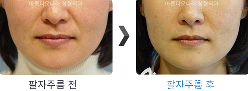 韓國吳金斯整形醫(yī)院埋線提升手術(shù)案例