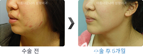 韓國吳金斯整形醫(yī)院面部吸脂手術(shù)對比案例