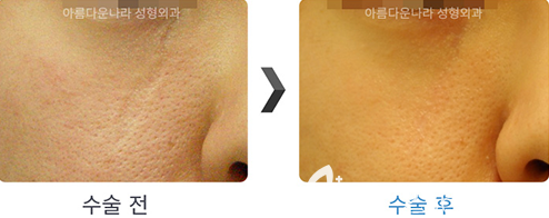 韓國吳金斯整形外科面部祛疤手術(shù)對比案例
