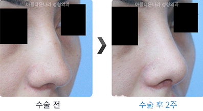 韓國吳金斯整形外科鷹鉤鼻矯正術(shù)前后照片對比圖
