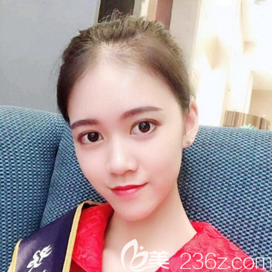 全臉自體脂肪面部填充術(shù)后12天恢復(fù)照片 全臉自體脂肪面部填充術(shù)后12天恢復(fù)照片