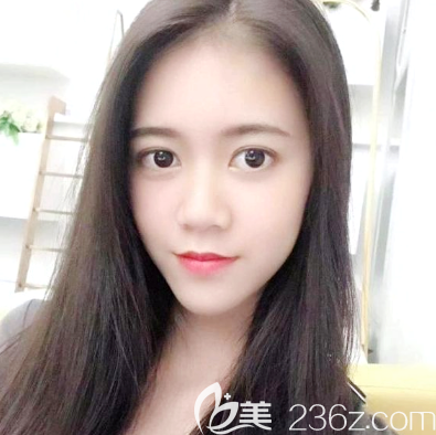 去東莞美立方找李志剛做自體脂肪面部填充全臉兩個月了,感覺脂肪成活率還不錯消腫也很快