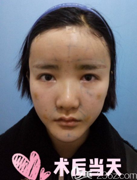 脂肪移植當(dāng)天 脂肪移植當(dāng)天