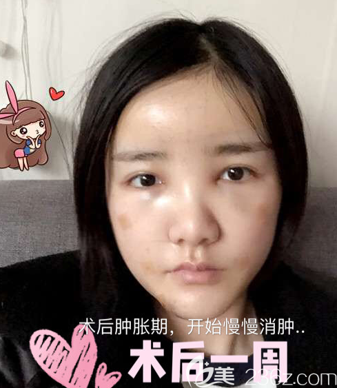 韓國(guó)寶士麗脂肪移植真人案例 韓國(guó)寶士麗脂肪移植真人案例