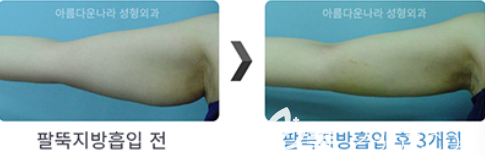 韓國吳金斯整形外科金鎮(zhèn)英手臂吸脂前后效果對比圖