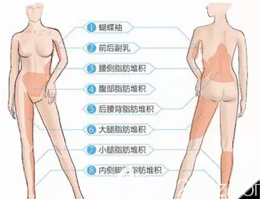 激光溶脂部位 激光溶脂部位