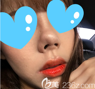 韓國(guó)博朗溫做鼻子怎么樣 韓國(guó)博朗溫做鼻子怎么樣