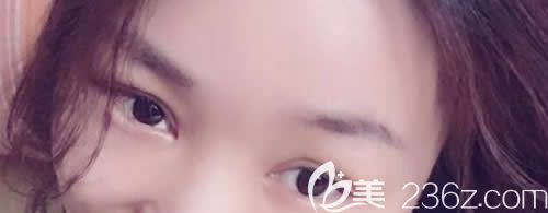 我在吉安天使整形做仿生無痕雙眼皮術(shù)后第6天效果