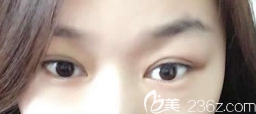 吉安天使整形袁寶玉院長給我做仿生無痕雙眼皮術(shù)后第18天恢復(fù)效果