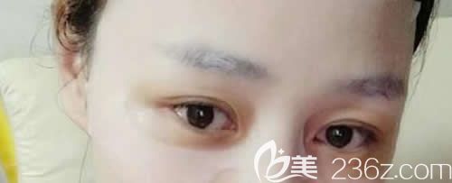 在吉安天使整形做仿生無痕雙眼皮價格4800元，一個月后朋友都說效果和價格成正比