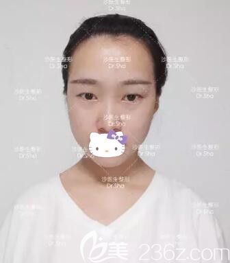 在大連沙醫(yī)生整形醫(yī)院做雙眼皮眼綜合術(shù)前照 在大連沙醫(yī)生整形醫(yī)院做雙眼皮眼綜合術(shù)前照