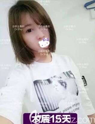 在大連沙醫(yī)生整形做完眼綜合術(shù)后半個月效果 在大連沙醫(yī)生整形做完眼綜合術(shù)后半個月效果