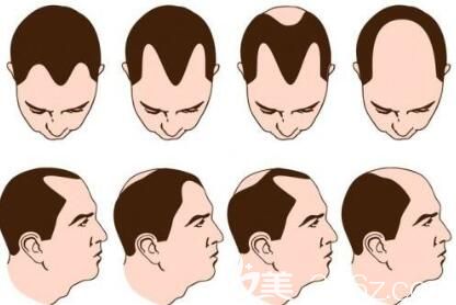 什么是自體脂肪疤痕植發(fā)