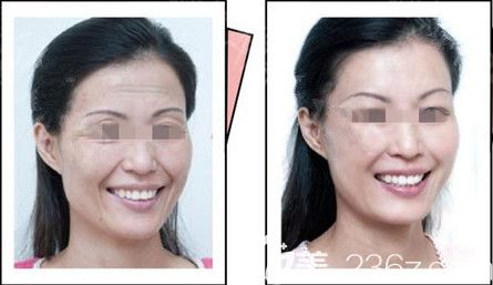 雅芳亞激光除皺案例