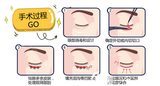 去眼袋流程圖