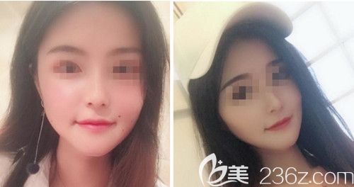 在韓國綺林做輪廓手術(shù)+面部脂肪填充手術(shù)后3個(gè)月