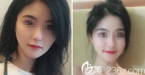 我在韓國(guó)綺林做3D顴骨+vline+面部脂肪填充后半年擺脫了我左右不對(duì)稱的臉型