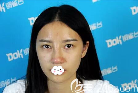 M22嫩膚治療術(shù)前照片 M22嫩膚治療術(shù)前照片