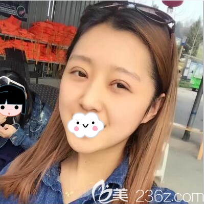 切開雙眼皮術(shù)后4天恢復(fù)照片